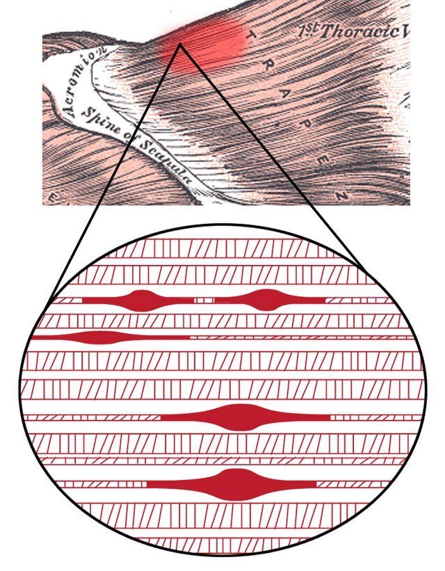 trigger point complex